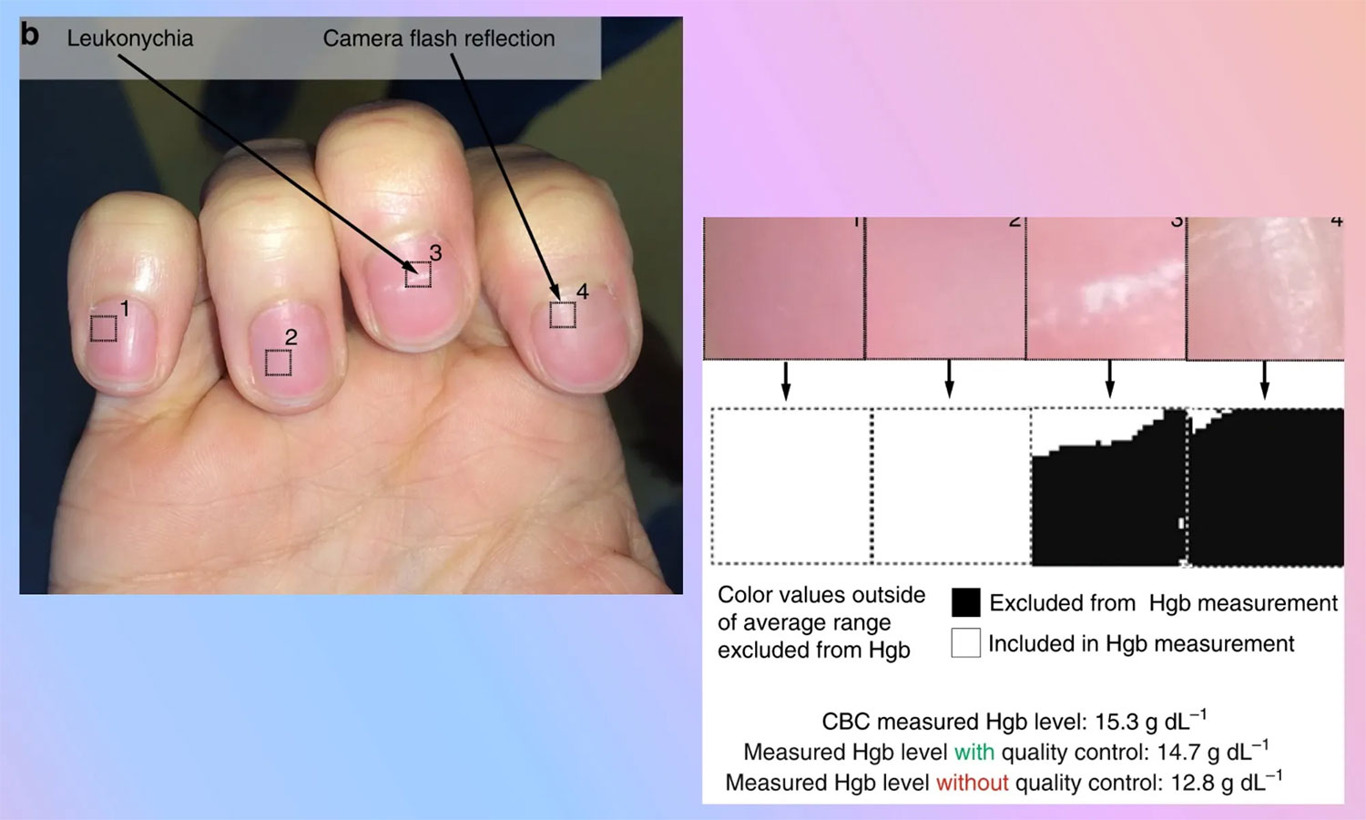 AI application detects anemia through nail photos: Medical solution for 2 billion people worldwide Picture 2