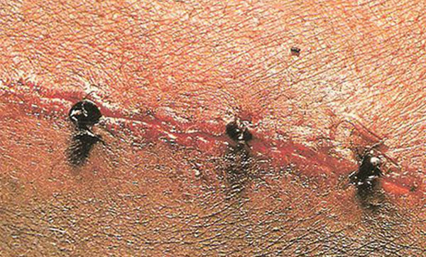 Army Ants: The Most Dangerous Ants on the Planet, With Teeth That Can Heal Human Wounds Picture 3