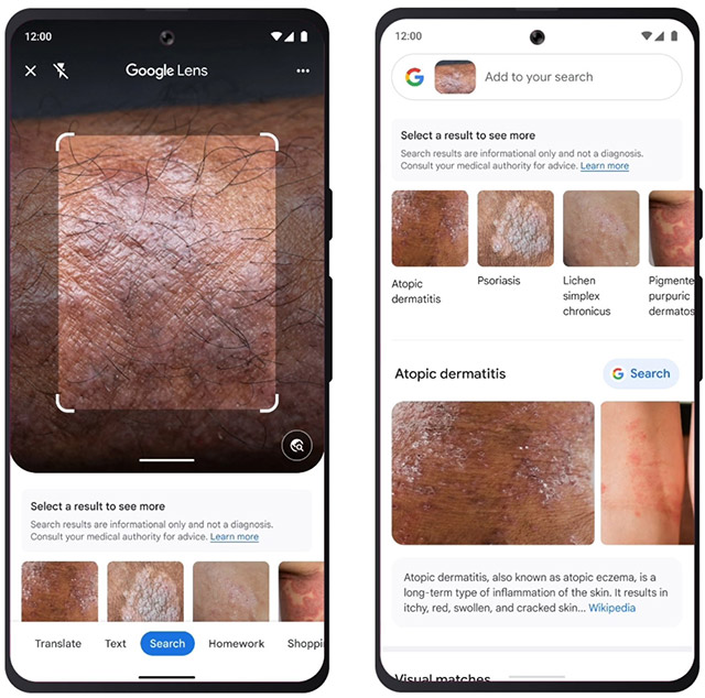 Google Lens has been updated with skin condition detection features Picture 1