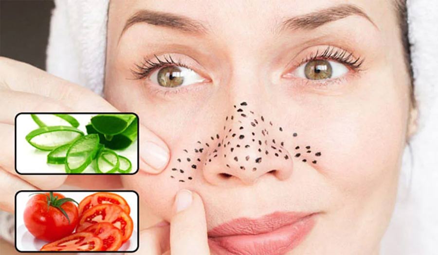 How to treat blackheads at home Picture 2