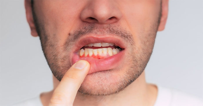 Small changes in your diet can help protect your gums. Picture 1