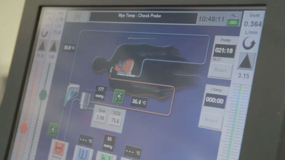 Picture 2 of Man survives 48 hours without lungs: An unprecedented medical miracle.