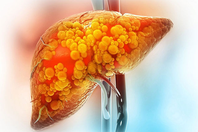 First potential treatment for dangerous fatty liver disease has been found Picture 1