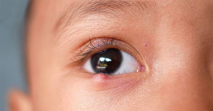 What to do when you have a stye Picture 1