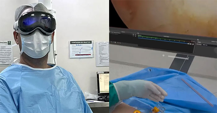 Apple Vision Pro Is Used in Shoulder Arthroscopic Surgery in Brazil Explained