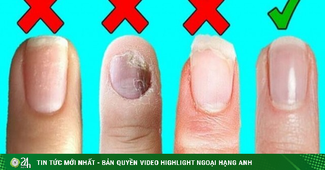Harvard Doctor Reveals Signs on Fingernails Predict Longevity