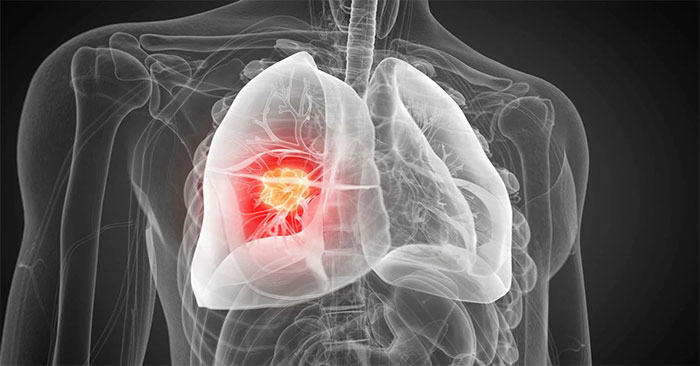 Targeted Gene Delivery Technology: New Prospects for Lung Cancer