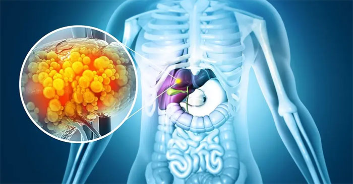 New Drug for Treating Fatty Liver MASH: Complete Guide