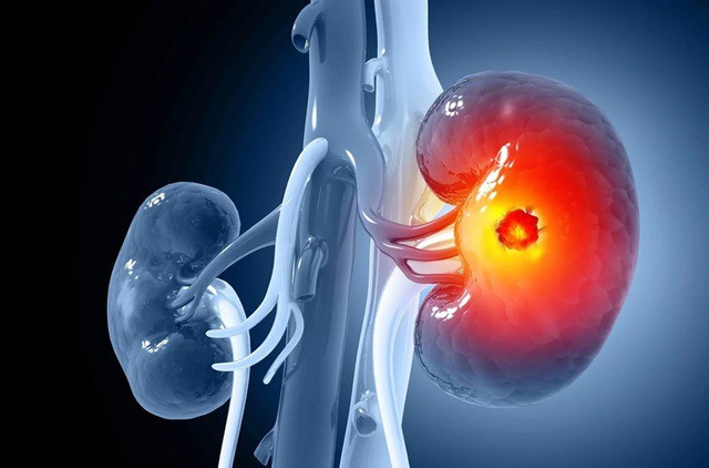 US: Breakthrough Kidney Cancer Vaccine Development
