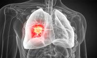 Targeted gene delivery technology: new prospects for lung cancer treatment
