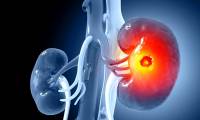 US: Breakthrough kidney cancer vaccine development