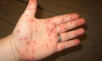 What is Hantavirus? How to prevent Hantavirus infection?