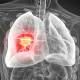 Targeted gene delivery technology: new prospects for lung cancer treatment