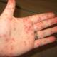 What is Hantavirus? How to prevent Hantavirus infection?